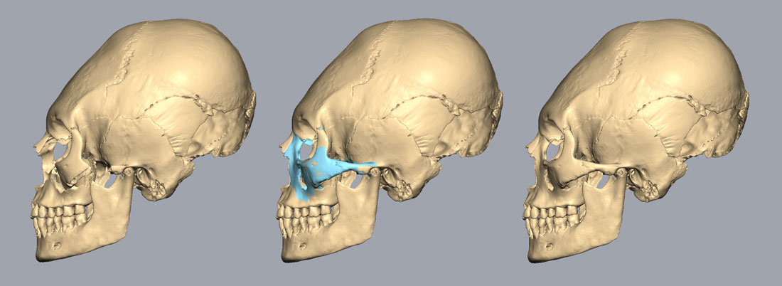 Skull reconstruction in profile view