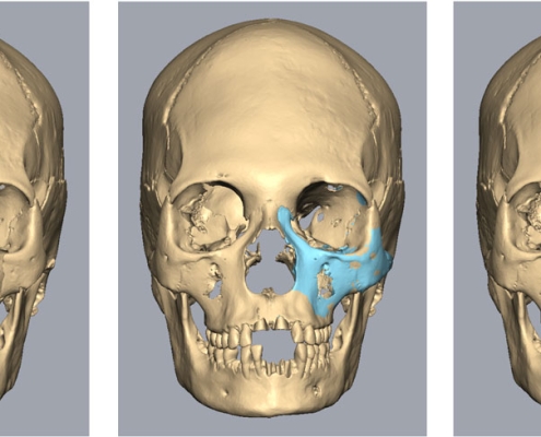 Skull reconstruction in frontal view