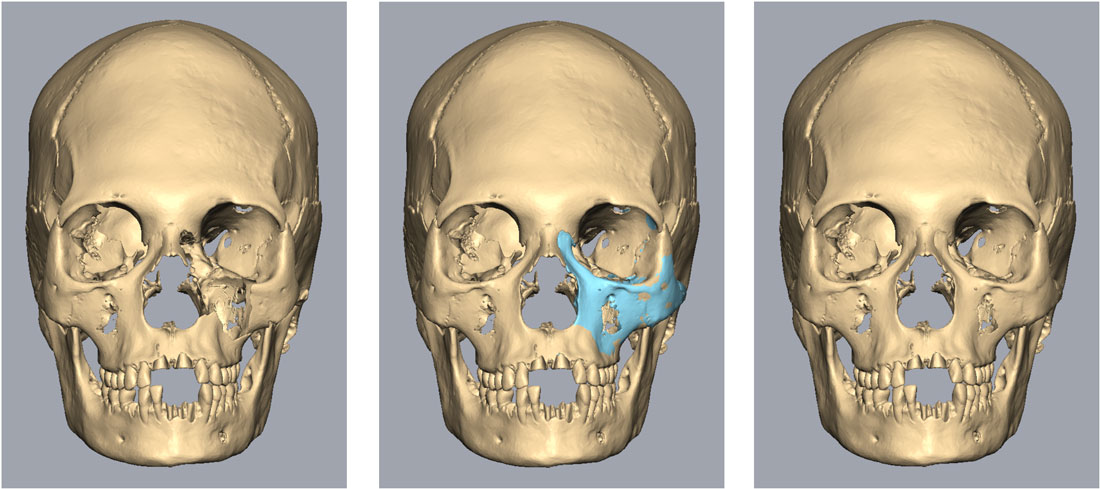 Skull reconstruction in frontal view