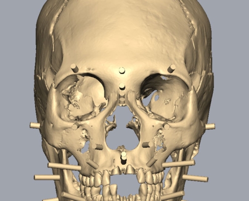 Skull with soft tissue pegs